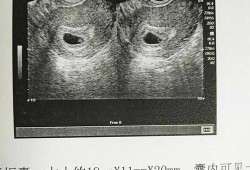 看胚胎形状测胎儿男女（看胚胎形状测胎儿男女准吗）