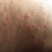 孕晚期孕妇湿疹手脚都有，奇痒无比，怎么办呀,孕期湿疹怎么止痒最快