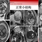 胎儿磁共振（新生儿照核磁共振是为什么）