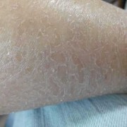 谁知道孕妇的腿上脱皮比较严重，应该怎么办,孕期皮肤脱皮是怎么回事