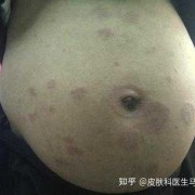 银屑病孕期（银屑病孕期）
