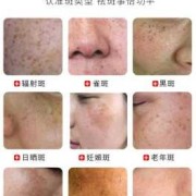 孕期雀斑（妊娠斑如何治疗）