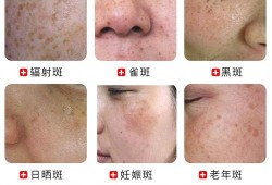孕期雀斑（妊娠斑如何治疗）