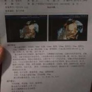 胎儿侧脑室（胎儿侧脑室正常值是多少）