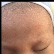 胎儿头部偏小（宝宝头上脱皮怎么办）