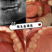 备孕期间可以拔智齿吗（备孕期间可以拔智齿吗）
