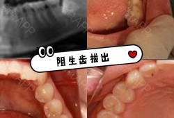 备孕期间可以拔智齿吗（备孕期间可以拔智齿吗）