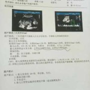 胎儿检查双肾窦稍分离，要紧吗,胎儿双侧肾窦分离应该注意什么