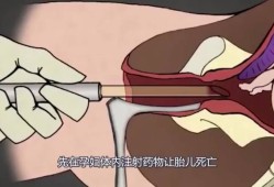 如何打掉胎儿（如何打掉胎儿危害小）