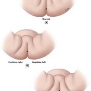 10个月宝宝大腿纹路不对称这正常不,胎儿腿直臀位什么意思