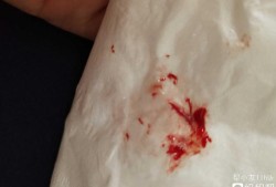 孕期流鼻血了（怀孕流鼻血是怎么回事）