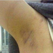 孕期腋臭（孕期腋臭）