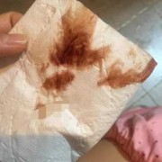 孕期出血图片（孕期出血图片真实）