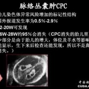 胎儿左侧脉络丛囊肿（胎儿左侧脉络丛囊肿是什么引起的）