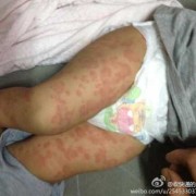 小孩起风团怎么办,胎儿泡大小约17-8mm