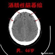 胎儿脑萎缩（胎儿脑萎缩能查出来吗）