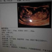 12周胎儿nt（12周胎儿nt值正常范围）