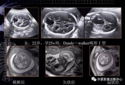 胎儿颅脑超声切面图（ct与磁共振有什么区别）