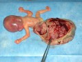 畸形胎儿（胎儿畸形的概率是多少）