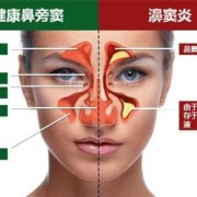 孕期鼻炎犯了怎么办（怀孕期间鼻炎严重怎么办）