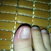 怀孕期间甲沟炎怎么办（怀孕期间甲沟炎怎么办）