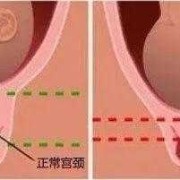 孕期宫颈缩短（孕期宫颈缩短）