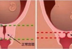 孕期宫颈缩短（孕期宫颈缩短）