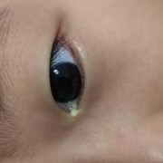 孕期眼屎多（孕期眼屎多怎么回事）