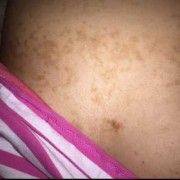 孕期胸上长斑（女性乳房下面突然出现色斑）