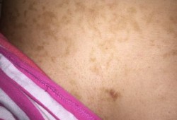 孕期胸上长斑（女性乳房下面突然出现色斑）