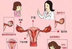 孕期盆腔炎（孕期盆腔炎有什么症状呢）