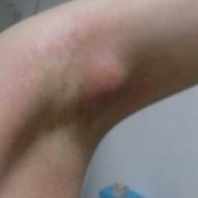 孕期腋下有肿块（腋下肿块是怎么回事）