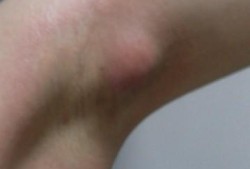 孕期腋下有肿块（腋下肿块是怎么回事）