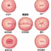 腹壁裂胎儿图片（蜘蛛腹部裂了一个口子如何挽救呀）