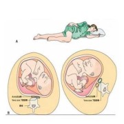 孕妇左侧睡体内胎儿图（孕妇左侧睡觉胎儿图片）