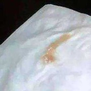 孕早期黄色分泌物怎么回事,怀孕期间有黄色分泌物正常吗