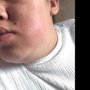 谁知道牙疼脸肿了要几天消肿呀,孕期脸肿了正常的吗