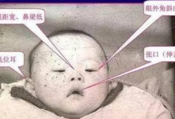 胎儿眼距小（胎儿眼距小有什么危害）