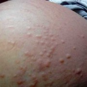 怀孕肚皮痒怎么回事,怀孕期间肚皮痒怎么回事