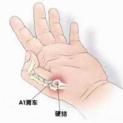 孕期腱鞘炎怎么办,孕期腱鞘炎怎么治疗最好最有效