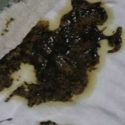 孕期拉黑屎（孕晚期贫血补铁大便怎么是黑色的，这是正常现象吗）