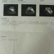 胎儿停止发育（胎儿停止发育）
