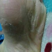 怀孕期间脚气严重怎么办（孕妇有脚气怎么办，特痒,孕妇有脚气怎么）