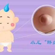 脐疝对宝宝有什么影响吗,胎儿脐疝属于畸形吗