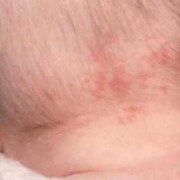 孕妇怎样防止孩子有胎记,怎么预防胎儿长胎记的方法