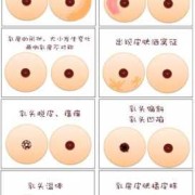 孕妇胸部里面有硬块需要揉散了吗,孕期乳房有硬块怎么办呢
