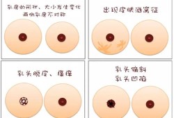 孕妇胸部里面有硬块需要揉散了吗,孕期乳房有硬块怎么办呢