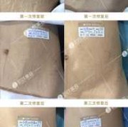 孕期长妊娠纹痒怎么办（孕妇妊娠纹痒可以涂炉甘石吗）