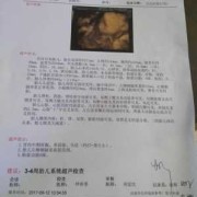 胎儿在又边（32周检查出来胎儿右侧侧脑室宽9.6mm）