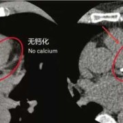 胎儿钙化是什么意思（胎儿钙化是什么意思?）